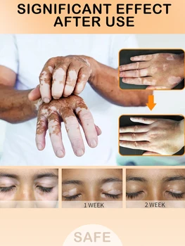 Tratamiento del vitiligo Eliminación de la piel de la mancha blanca crema de Inhibir la propagación de vitiligo Quitar la tiña de la mancha blanca